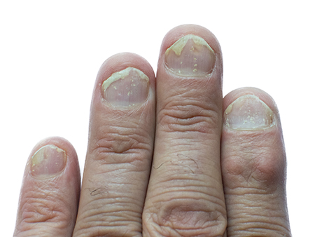 Surface appearance in Nail Psoriasis 