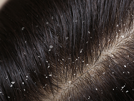 Six Tips to Fight Flakes - The Hair Loss Clinic | Dr. Balvant Arora