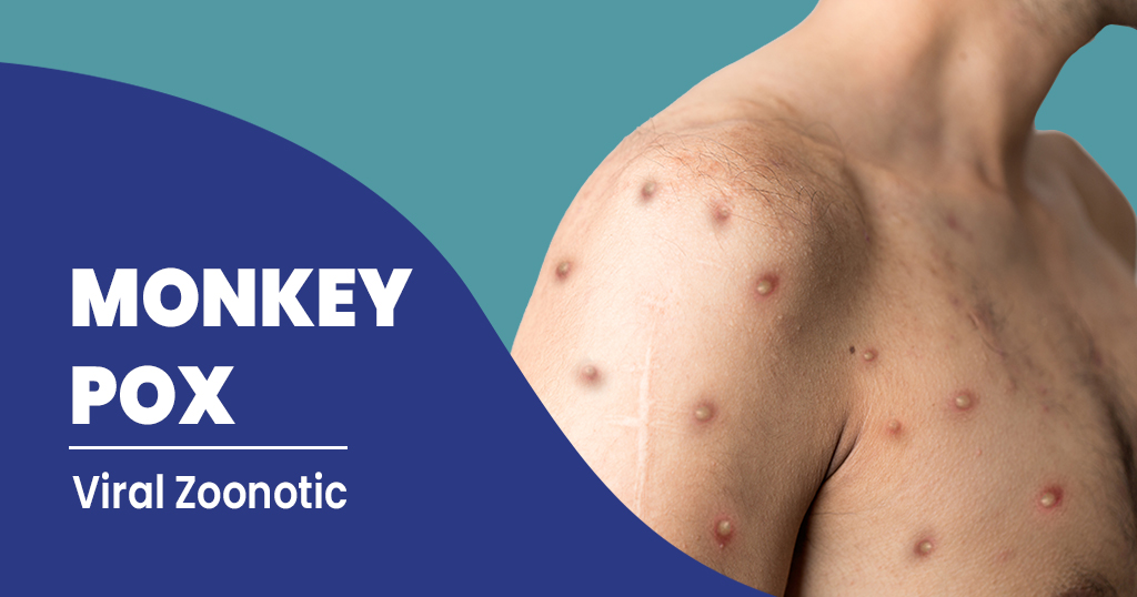 Monkeypox – Symptoms, Diagnosis, Prevention and more - Star Health