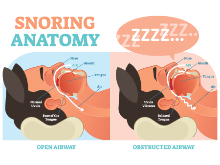 Difference between normal airway and obstructed airway