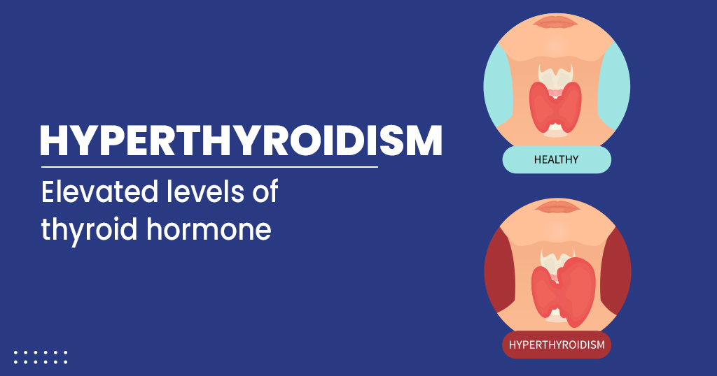 Hyperthyroidsm