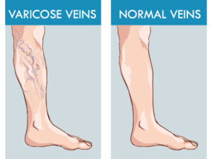 Normal veins vs Varicose veins