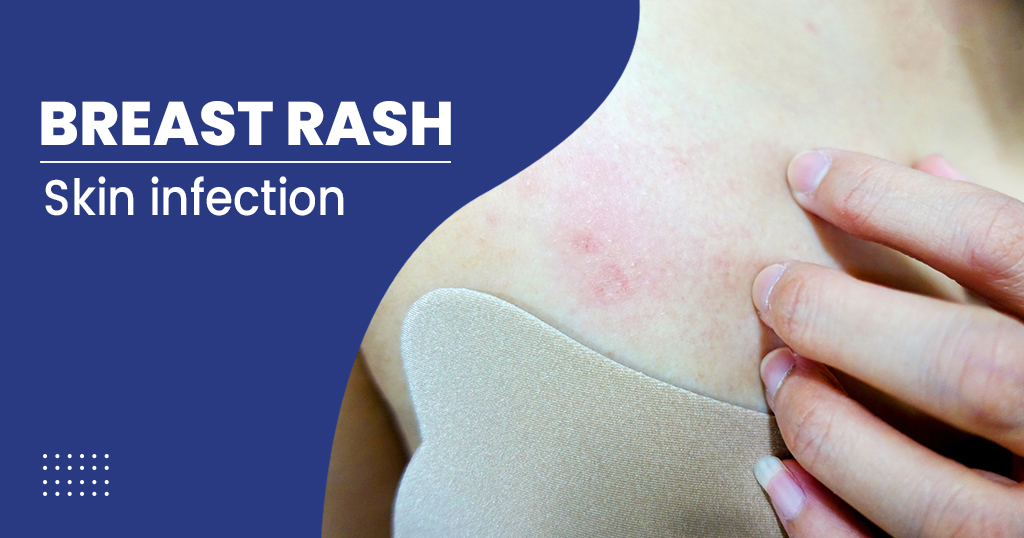 scaring Til Ni udendørs Breast rash - Symptoms, Causes, Treatments, and Prevention