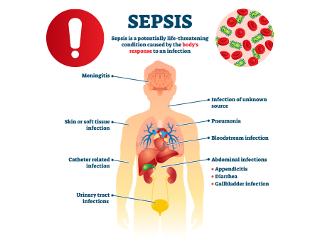 Symptoms of Sepsis 