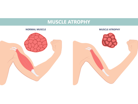 Muscle Atrophy of Nerve damage