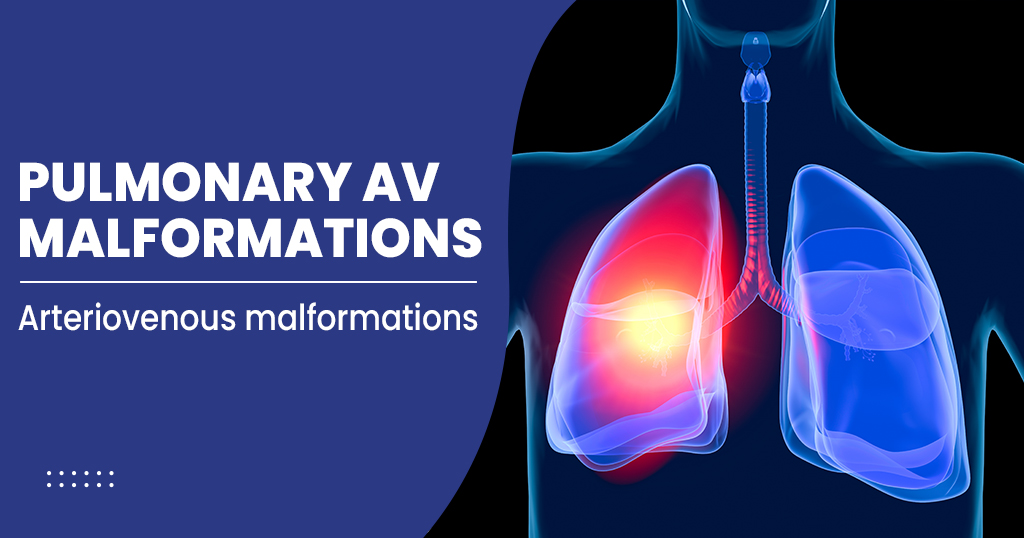 Pulmonary AV Malformations