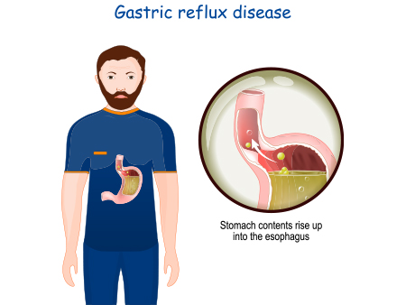 Gastric Reflux disease in Acidity 