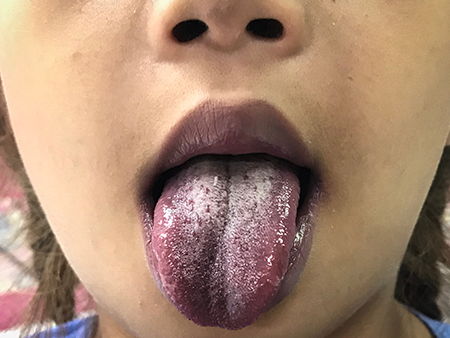 tongue-cancer