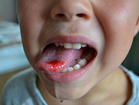 injured-tongue