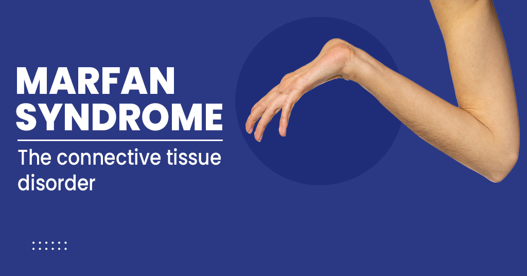 Marfan syndrome - Symptoms, Causes, Treatments and more