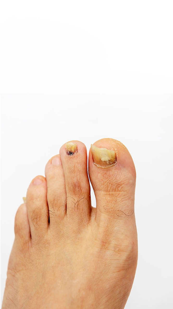 Preventing Toenail Fungal Infections: Essential Tips for Athletes