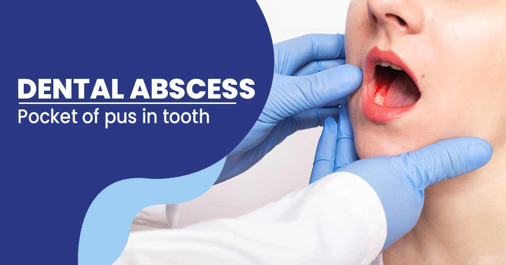 Dental-abscess