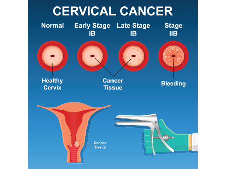 Stages of Cervical Cancer 