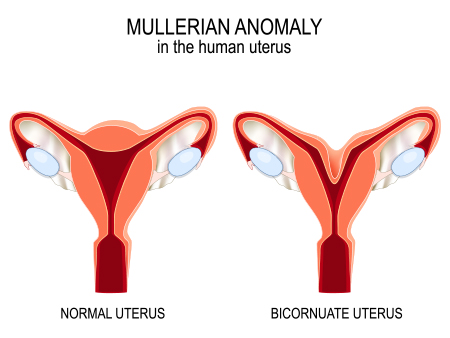 bicornuate uterus
