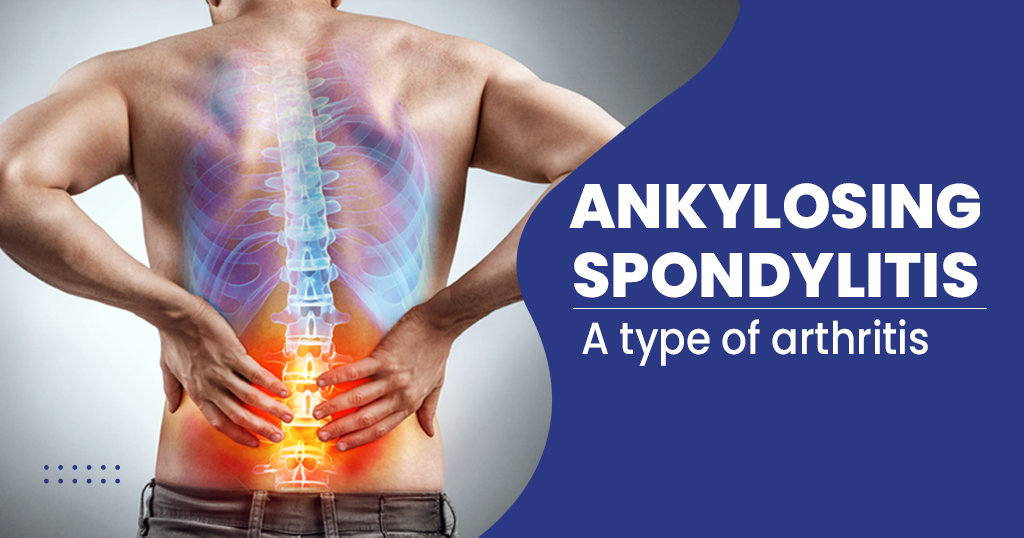 What Is Ankylosing Spondylitis Symptoms Causes Treatment And Prevention