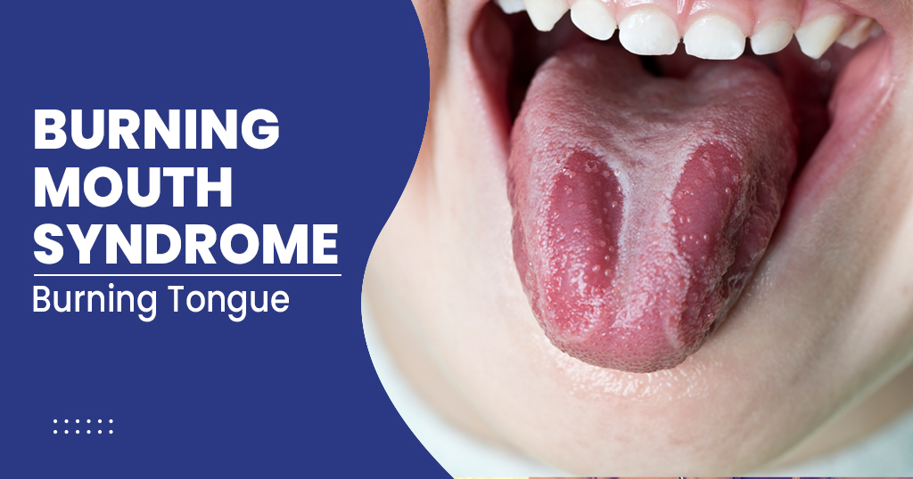 Burning Mouth syndrome
