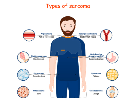 Types of Sarcoma
