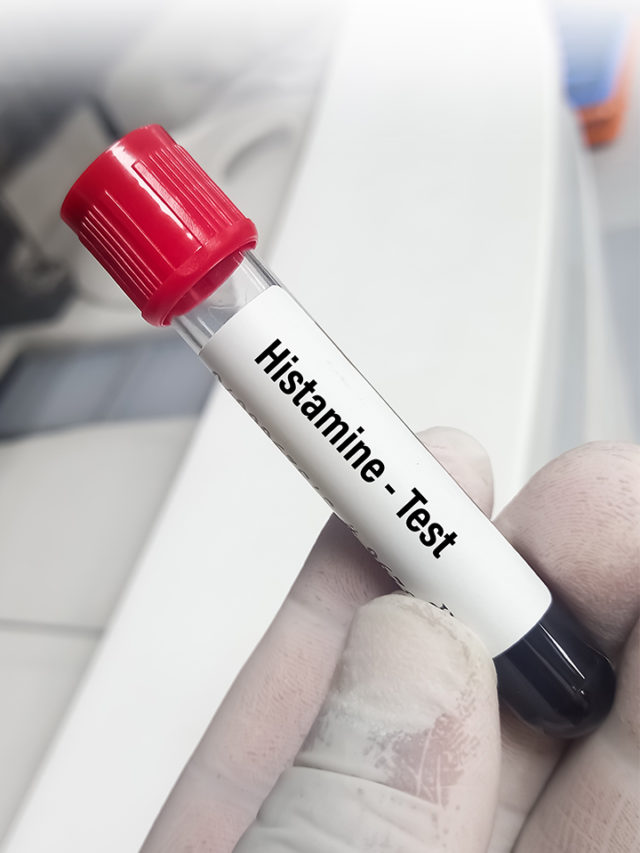 8 symptoms of histamine intolerance