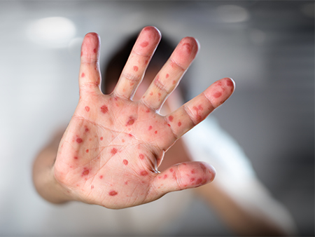child with measles