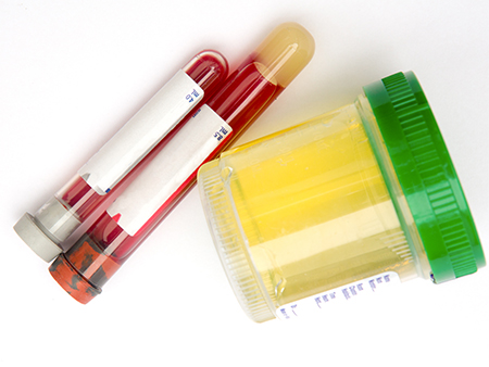 blood and urine test
