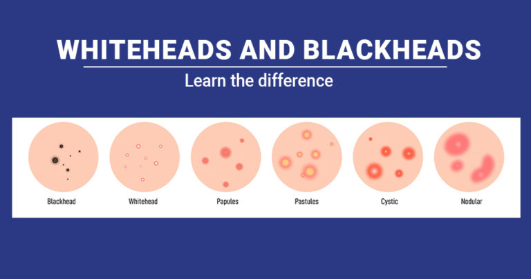 Whiteheads and blackheads