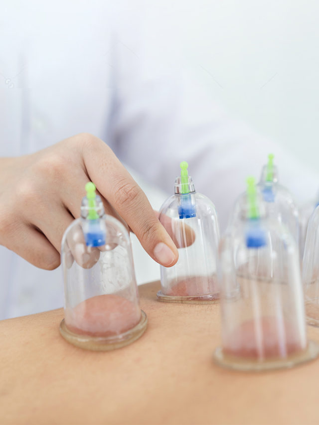 Cupping Therapy and its Types