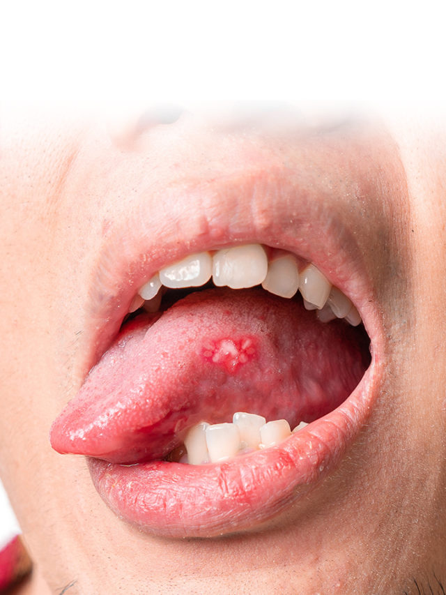 Ways To Treat Tongue Blisters