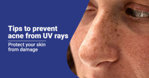 prevent acne caused by UV rays